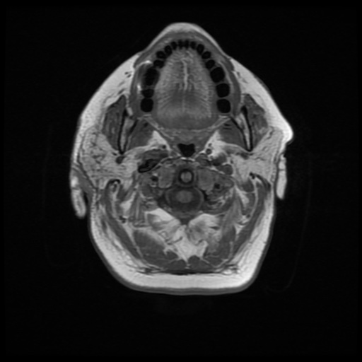 File:Acute otitis externa (Radiopaedia 57296-64236 Axial T1 13).jpg