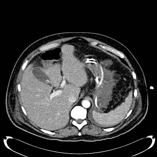 Acute pancreatic necrosis (Radiopaedia 13560-18500 Axial C+ portal venous phase 36).jpg