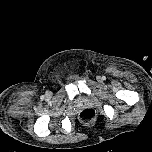File:Acute pancreatic necrosis (Radiopaedia 13560-18501 Axial C+ portal venous phase 150).jpg