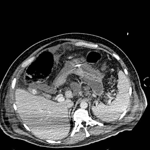 Acute pancreatic necrosis (Radiopaedia 13560-18501 Axial C+ portal venous phase 32).jpg