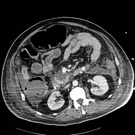 Acute pancreatic necrosis (Radiopaedia 13560-18502 Axial C+ portal venous phase 42).jpg