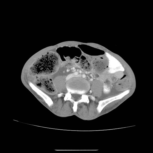 File:Acute pancreatitis (Radiopaedia 50213-55558 Axial C+ portal venous phase 34).jpg