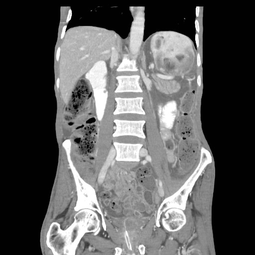 File:Acute pancreatitis (Radiopaedia 50213-55558 Coronal C+ portal venous phase 24).jpg