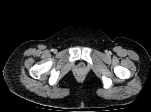 Acute pancreatitis (Radiopaedia 69236-79012 Axial C+ portal venous phase 90).jpg