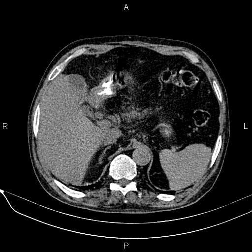Acute pancreatitis (Radiopaedia 85146-100701 Axial non-contrast 34).jpg