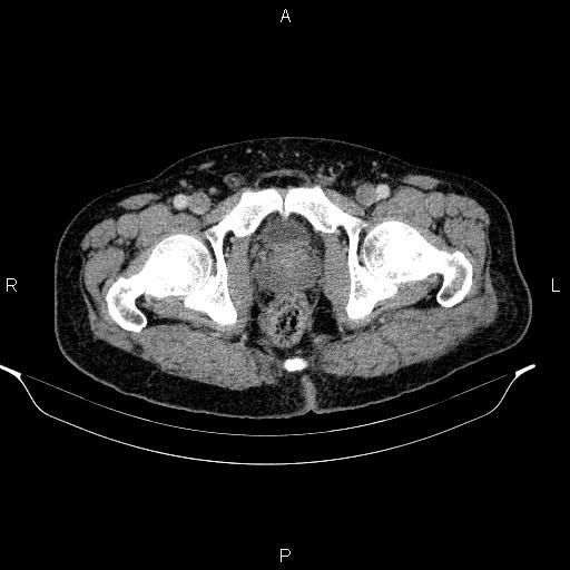 Acute pancreatitis (Radiopaedia 85390-101010 Axial C+ portal venous phase 108).jpg
