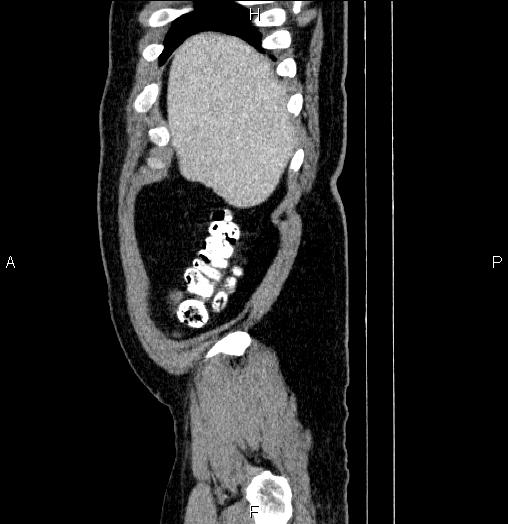 Acute pancreatitis (Radiopaedia 85390-101010 Sagittal C+ portal venous phase 6).jpg