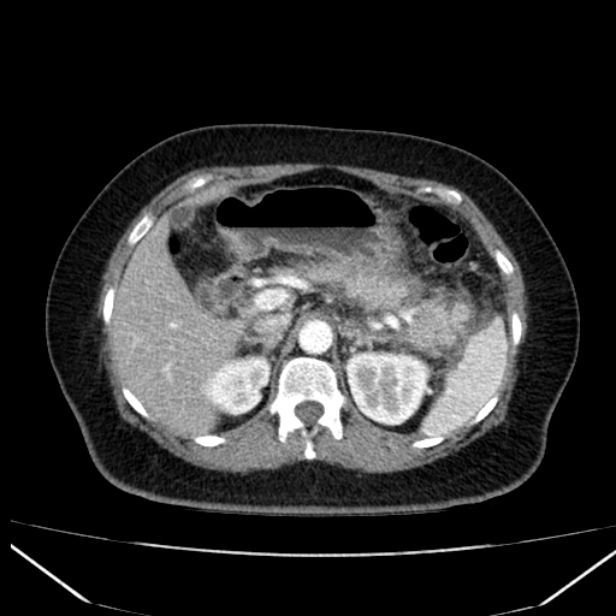 Acute pancreatitis - Balthazar C (Radiopaedia 26569-26714 Axial C+ arterial phase 27).jpg