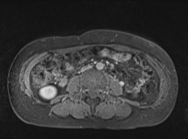 Acute pancreatitis - Balthazar E - post ERCP (Radiopaedia 27562-27778 F 71).png