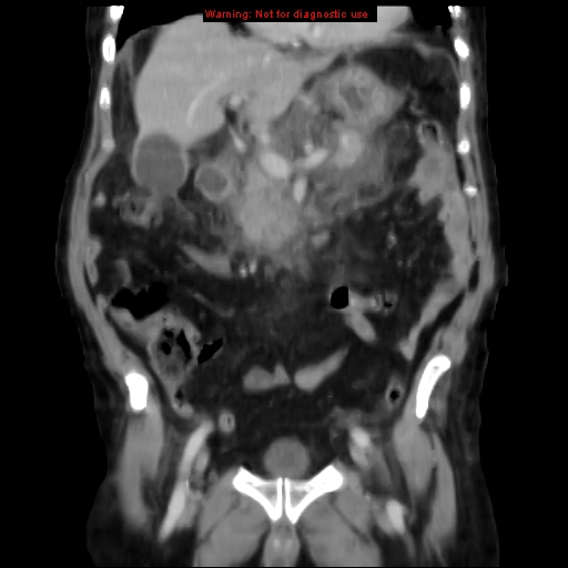 Acute pancreatitis with incidental pancreatic lipoma (Radiopaedia 10190-10730 Coronal C+ portal venous phase 28).jpg