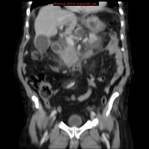 Acute pancreatitis with incidental pancreatic lipoma (Radiopaedia 10190-10730 Coronal C+ portal venous phase 29).jpg