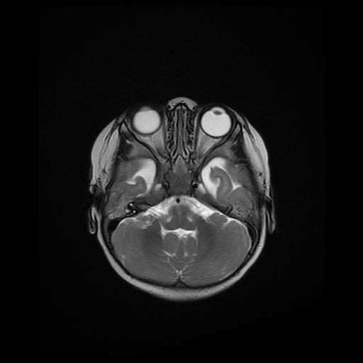 File:Acute phase of hemiconvulsion-hemiplegia epilepsy syndrome (Radiopaedia 29309-29745 Axial T2 18).jpg