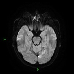 Acute posterior cerebral artery territory infarct (Radiopaedia 79329-92394 Axial DWI 11).jpg