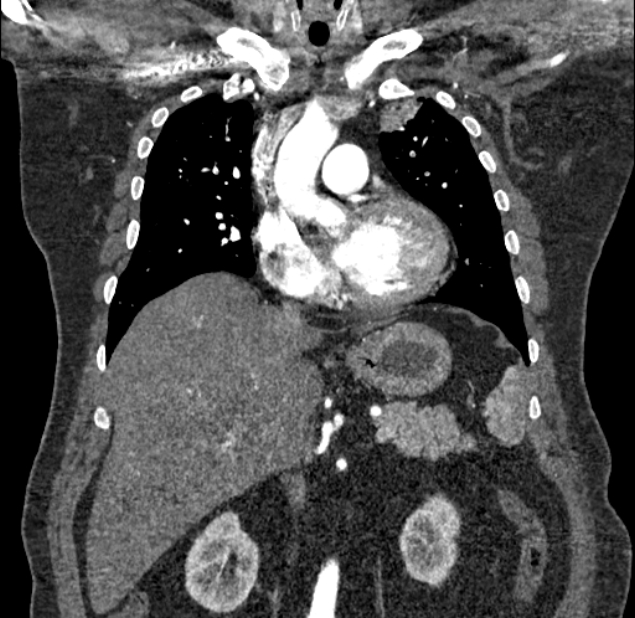 Acute pulmonary embolism with pulmonary infarcts (Radiopaedia 77688-89908 Coronal C+ CTPA 34).jpg