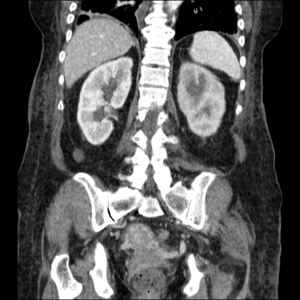 Acute pyelonephritis (Radiopaedia 26584-26729 C+ portal venous phase 52).jpg