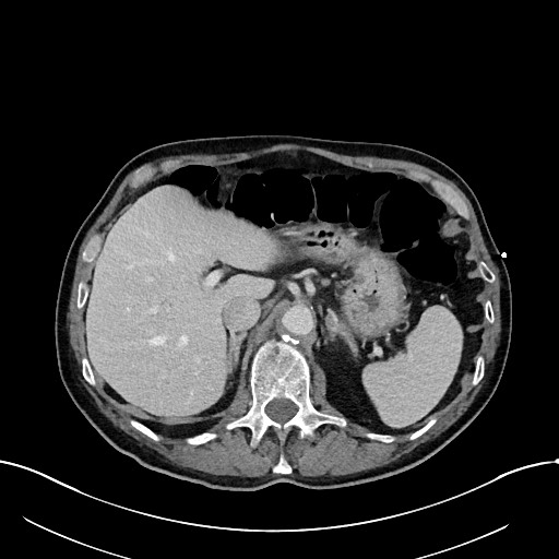 File:Acute renal infarction (Radiopaedia 59375-66736 Axial C+ portal venous phase 23).jpg