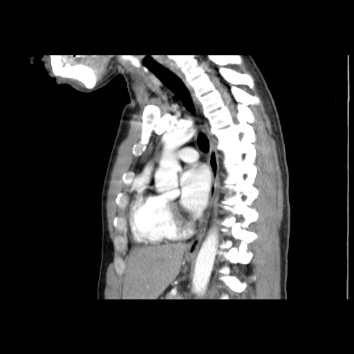 File:Acute segmental pulmonary emboli and pulmonary infarction (Radiopaedia 62264-70444 Sagittal C+ CTPA 37).jpg