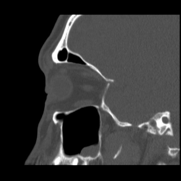 Acute sinusitis (Radiopaedia 23161-23215 Sagittal bone window 20).jpg