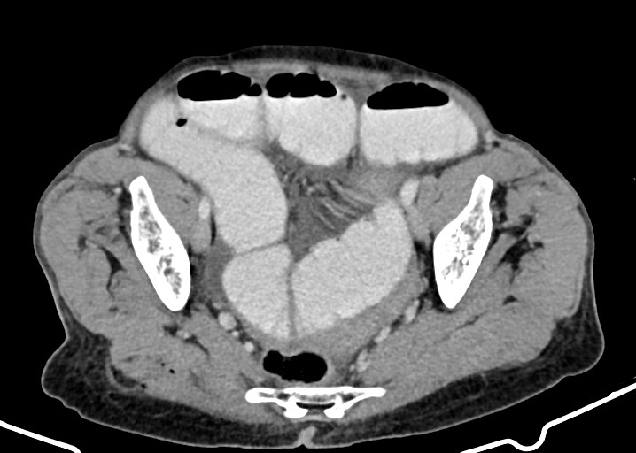Acute small bowel (ileal) volvulus (Radiopaedia 71740-82139 Axial C+ portal venous phase 167).jpg