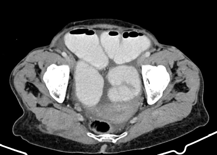 Acute small bowel (ileal) volvulus (Radiopaedia 71740-82139 Axial C+ portal venous phase 175).jpg
