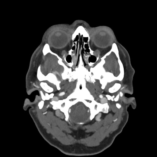 Acute subarachnoid hemorrhage and accessory anterior cerebral artery (Radiopaedia 69231-79009 D 10).jpg