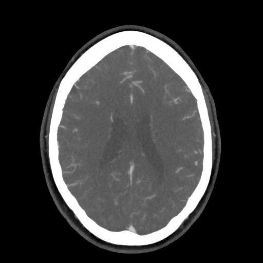 Acute subarachnoid hemorrhage and accessory anterior cerebral artery (Radiopaedia 69231-79009 D 45).jpg