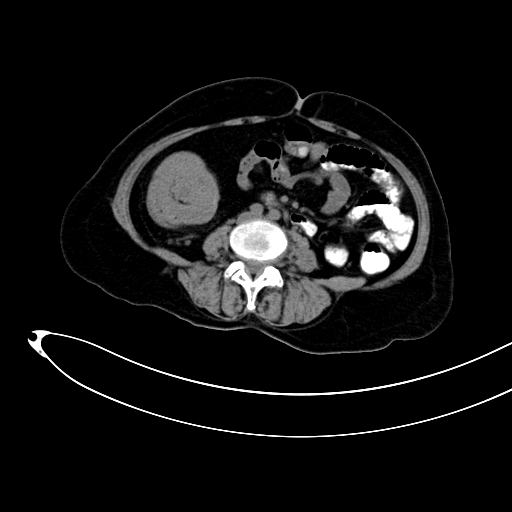 Adenocarcinoma colon with intussusception (Radiopaedia 86006-101922 Axial non-contrast 31).jpg