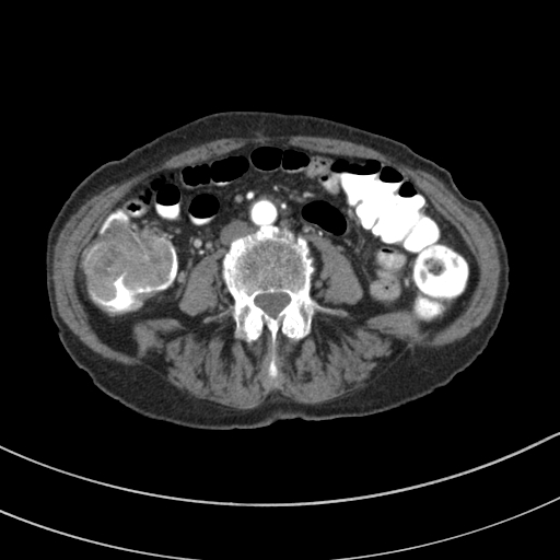 Adenocarcinoma of cecum (Radiopaedia 59222-66549 Axial C+ arterial phase 85).jpg