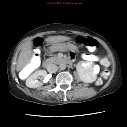 Adenocarcinoma of the colon (Radiopaedia 8191-9039 Axial renal excretory phase 18).jpg