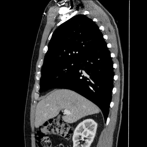 Adenocarcinoma of the lung (Radiopaedia 59871-67325 Sagittal C+ arterial phase 30).jpg