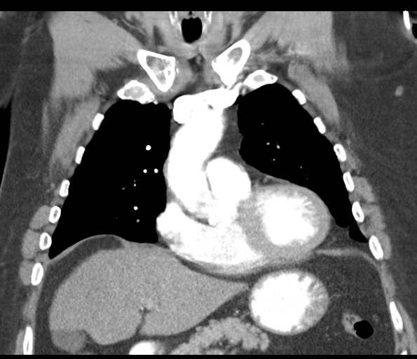 Adenocarcioma of rectum- T1 lesion (Radiopaedia 36921-38547 Coronal C+ arterial phase 24).png
