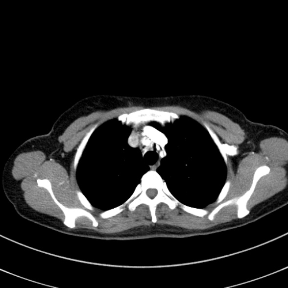 Adenocystic carcinoma of the trachea (Radiopaedia 47677-52525 Axial C+ arterial phase 37).jpg
