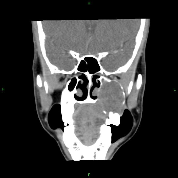 File:Adenoid cystic carcinoma of hard palate (Radiopaedia 26137-26273 Coronal liver window 12).jpg