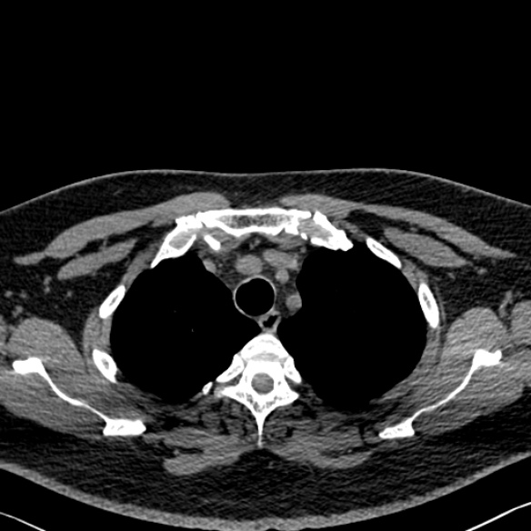 Adenoid cystic carcinoma of the trachea (Radiopaedia 49042-54137 Axial non-contrast 64).jpg