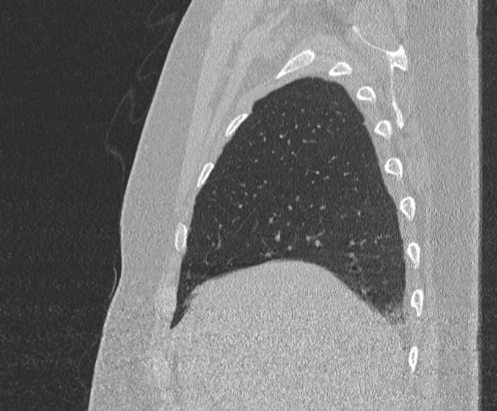 Adenoid cystic carcinoma of the trachea (Radiopaedia 49042-54137 Sagittal lung window 90).jpg