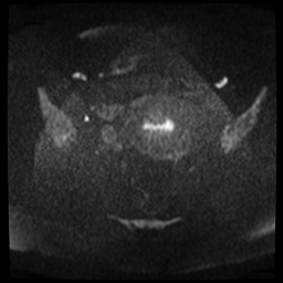 File:Adenomyosis-scar endometriosis (Radiopaedia 65863-75022 Axial DWI 7).jpg