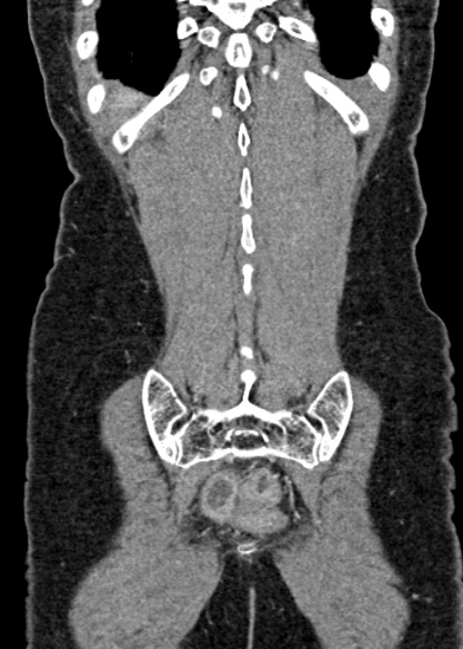 Adhesional small bowel obstruction (Radiopaedia 48397-53305 Coronal C+ portal venous phase 306).jpg