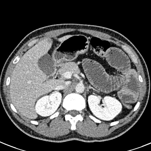 Adhesional small bowel obstruction (Radiopaedia 58900-66131 Axial C+ portal venous phase 16).jpg