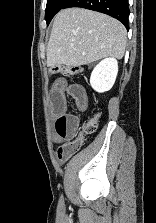 Adhesional small bowel obstruction (Radiopaedia 58900-66131 Sagittal C+ portal venous phase 60).jpg