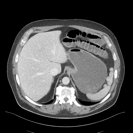 Adhesions within abdominal wall hernia (Radiopaedia 58283-65394 Axial C+ portal venous phase 18).png
