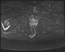Adnexal multilocular cyst (O-RADS US 3- O-RADS MRI 3) (Radiopaedia 87426-103754 Axial DWI 53).jpg