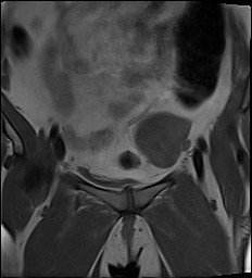 File:Adnexal multilocular cyst (O-RADS US 3- O-RADS MRI 3) (Radiopaedia 87426-103754 Coronal 9).jpg