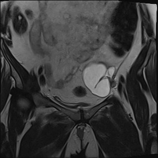 File:Adnexal multilocular cyst (O-RADS US 3- O-RADS MRI 3) (Radiopaedia 87426-103754 Coronal T2 10).jpg