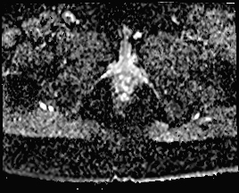 File:Adnexal multilocular cyst (O-RADS US 3. O-RADS MRI 3) (Radiopaedia 87426-103754 Axial 174).jpeg