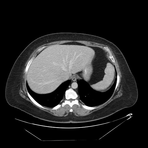 Adrenal angiosarcoma (Radiopaedia 81081-94671 Axial C+ portal venous phase 11).jpg
