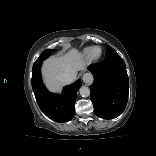 File:Adrenal collision tumor (ACT) (Radiopaedia 48462-53379 Axial C+ delayed 9).jpg
