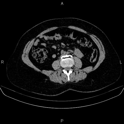 File:Adrenal cortical carcinoma (Radiopaedia 84882-100379 Axial non-contrast 50).jpg