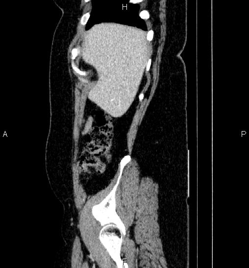 File:Adrenal cortical carcinoma (Radiopaedia 84882-100379 Sagittal C+ portal venous phase 12).jpg