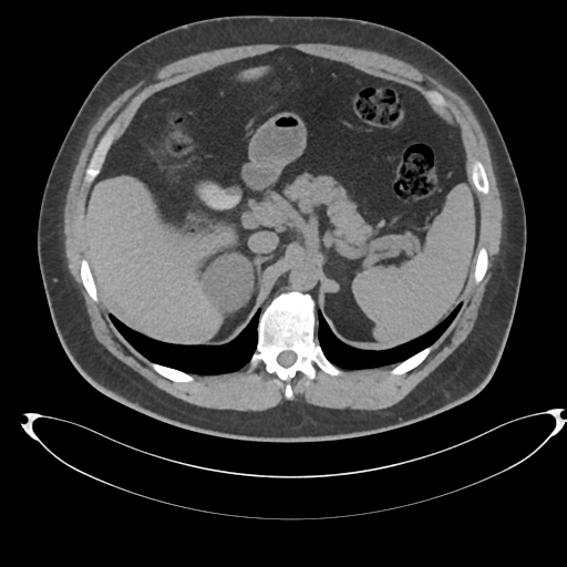 Adrenal cyst (Radiopaedia 45625-49778 Axial non-contrast 28).png