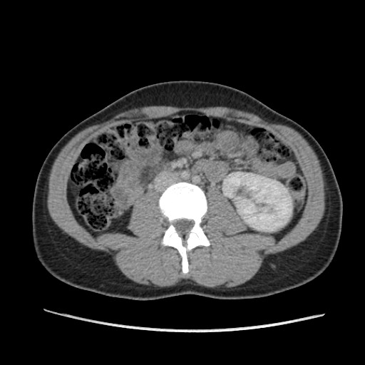 File:Adrenal cyst (Radiopaedia 64869-73813 Axial C+ portal venous phase 40).jpg